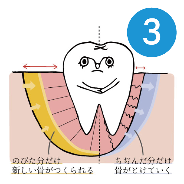 マウスピースによる歯列矯正3